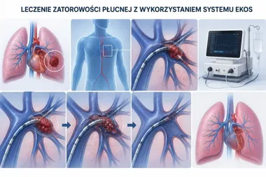 EKOS w Łodzi celuje w skrzeplinę. Lekarze skracają drogę do stabilizacji